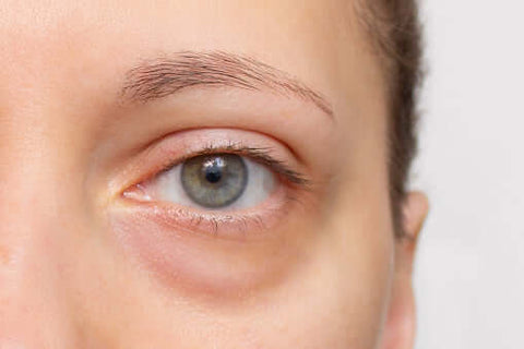 Say Goodbye to Puffiness: The Ultimate Guide to Treatment for Under Eyes Bags